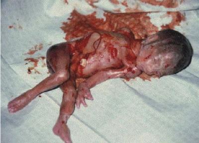 20080308171552-aborto3.jpg